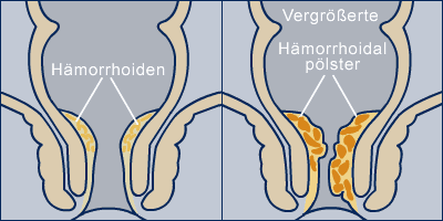 Hämorrhoiden 