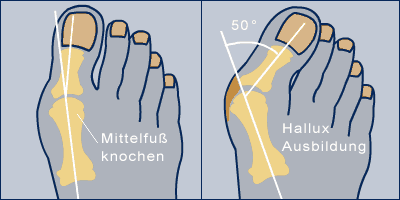 Hallux valgus - Vorfußchirurgie